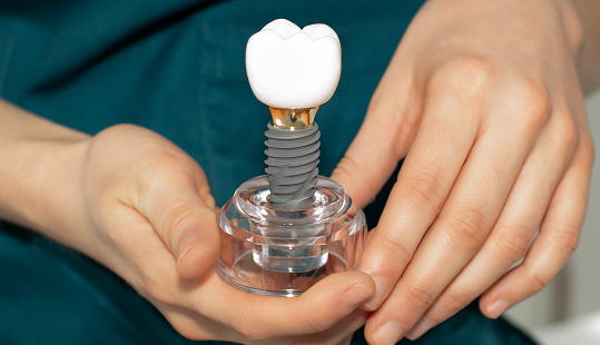 Dental Implants